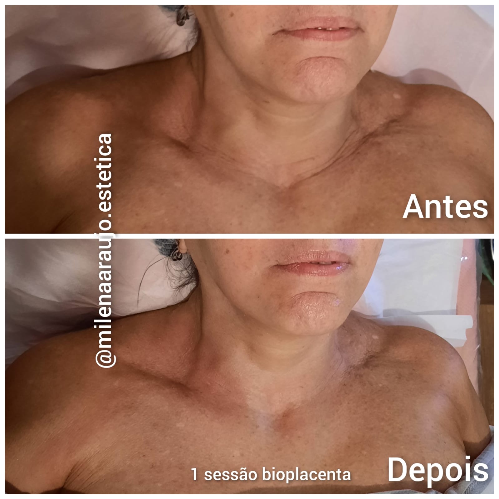 Rejuvenescimento de pescoço e colo