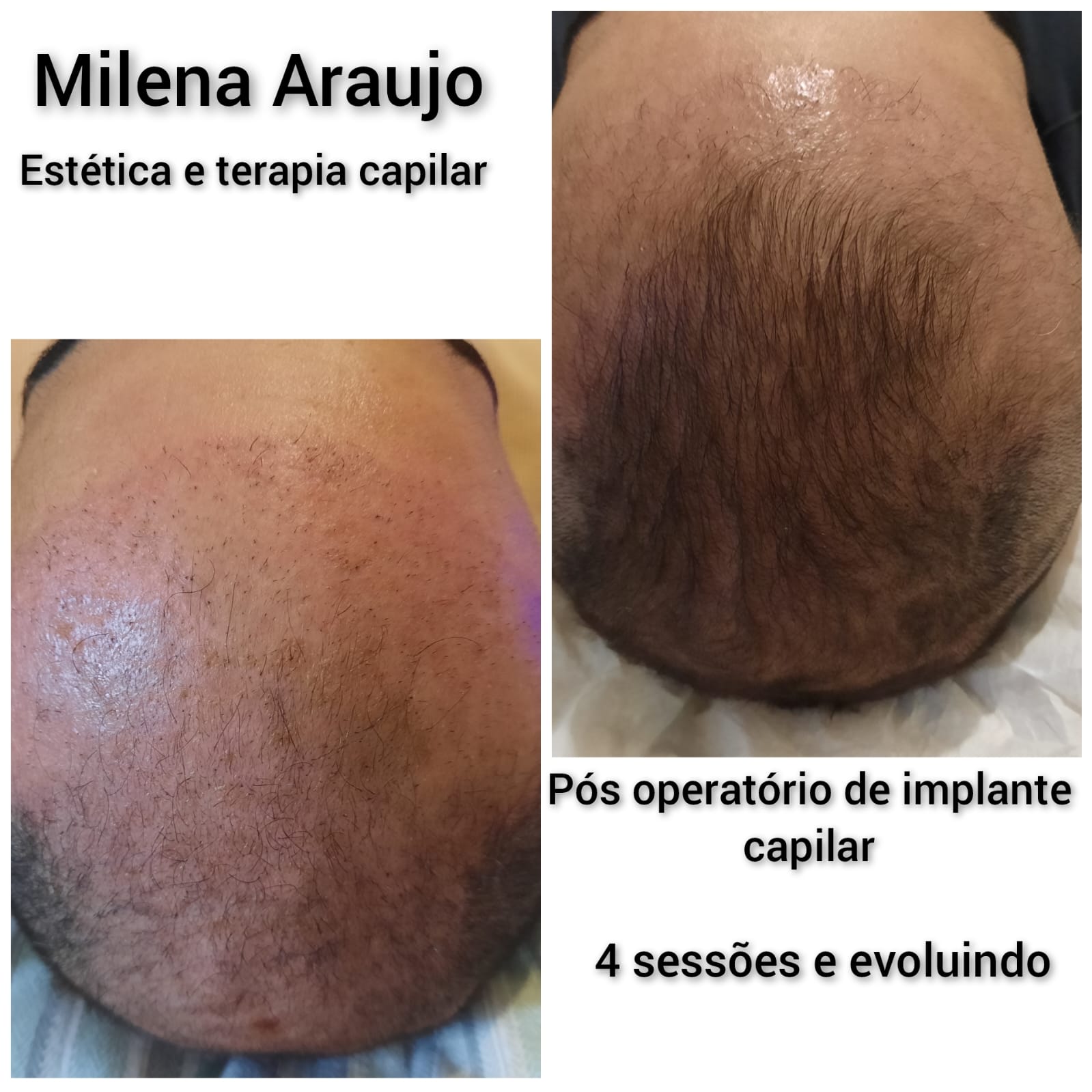 Pós operatório de implante capilar