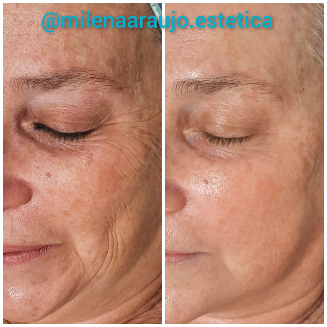 Tratamento para rejuvenescimento