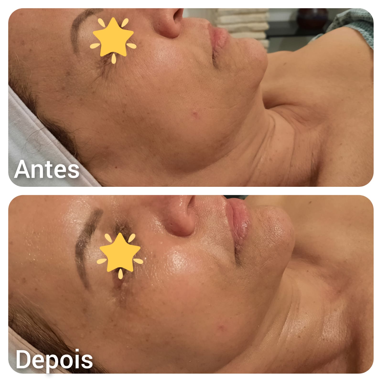 Skin booster